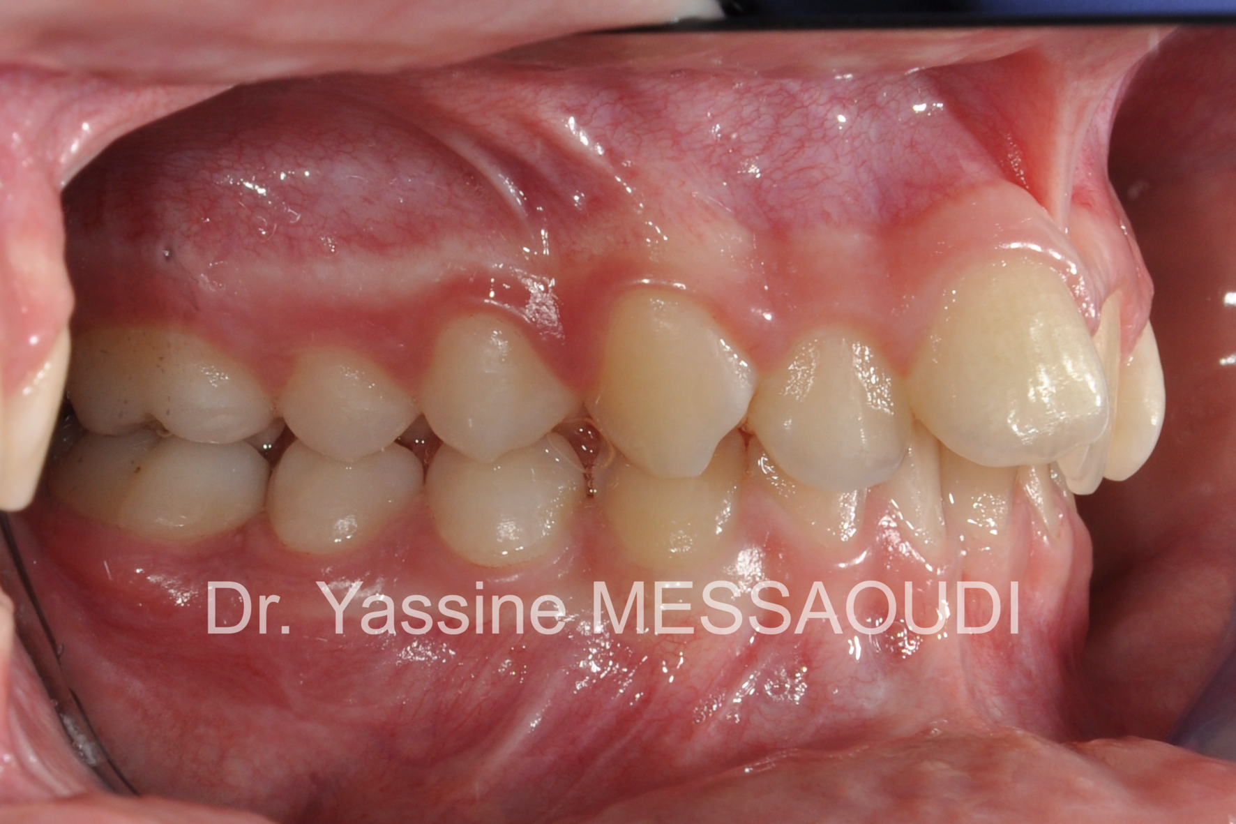 Classe II - Avant traitement